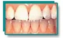Restored bright white teeth after professional whitening for aged stains