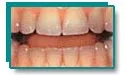 Teeth with age-related yellowing and darkening before whitening treatment