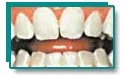 Bright white teeth after professional whitening treatment for genetic stains
