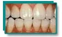 Improved teeth appearance after professional whitening for tetracycline stains