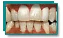 Clean white teeth after professional whitening removed tobacco stains