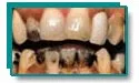 Teeth with deep tobacco staining and brown discoloration before whitening